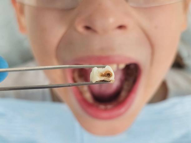 Best Emergency Wisdom Tooth Extraction in Krebs, OK